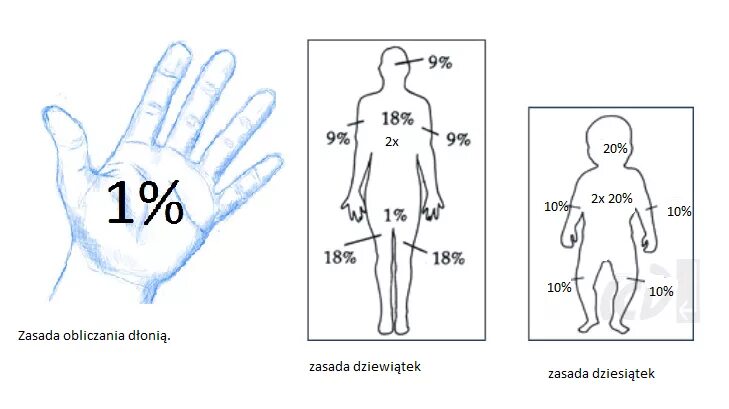 площадь ожога передней поверхности туловища. площадь ожога у взрослых. термический ожог правило девяток. ожоги правило девяток у детей. площадь ожога у взрослых.
