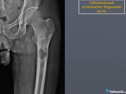 Туберкулезное поражение костей