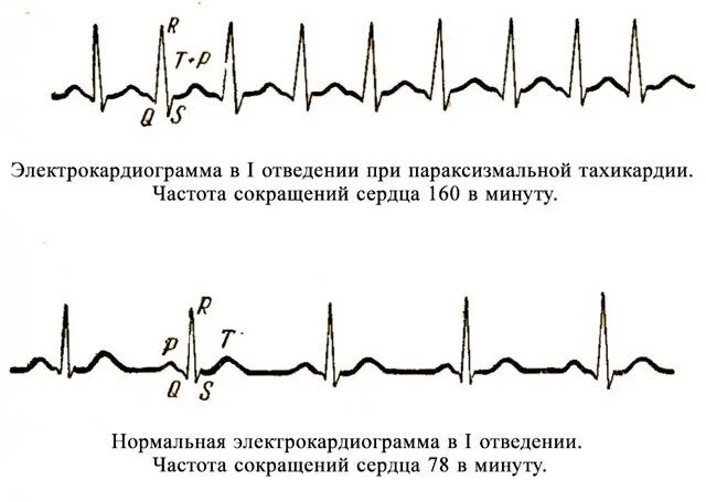 Синусовая риентри тахикардия. Экг патология синусовая тахикардия. Пароксизмальная синусовая тахикардия. Экг при минусовой тахиаритмии. Нарушение сердечного ритма синусовая тахикардия.
