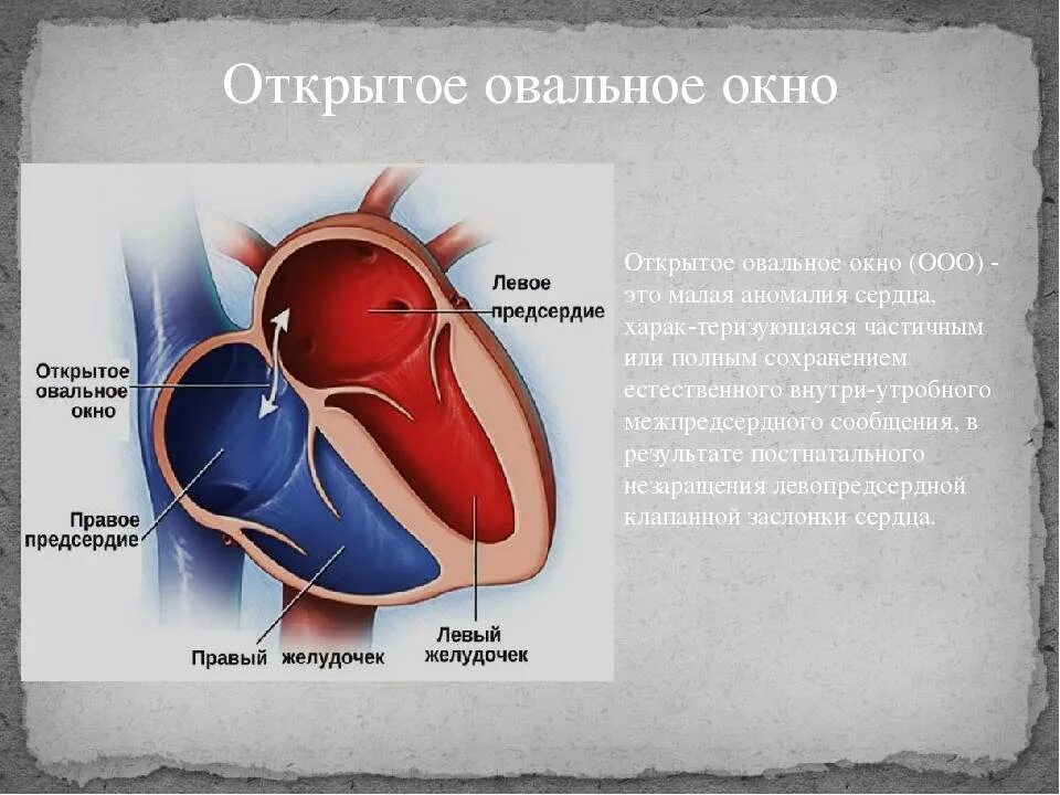 1 3 окно в сердце. Открытое овальное окно у новорожденного 2 мм. Овальное окно в сердце новорожденных располагается. Сердце анатомия человека овальное окно. Открытое овальное окно у новорожденных в 1 месяц 2 мм.