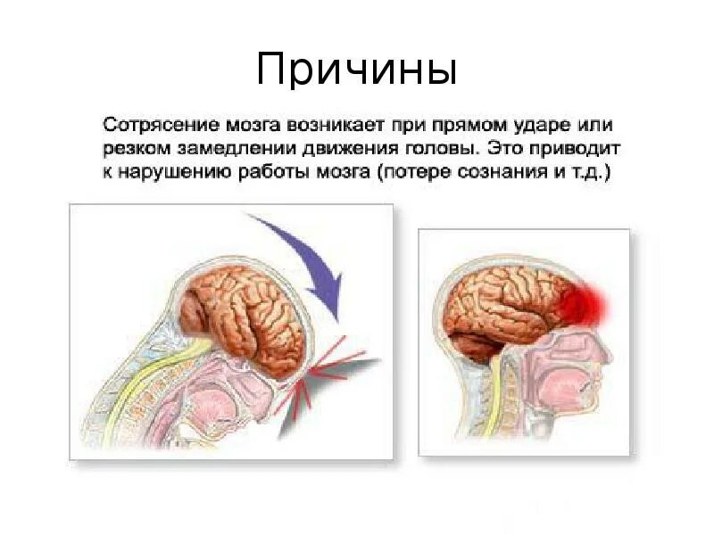 Сотрясение головного мозга. Отрясениеголовного мозга. Черепно мозговая травма сотрясение. Черепно-мозговые травмы, сотрясение мозга. Спать при сотрясении мозга