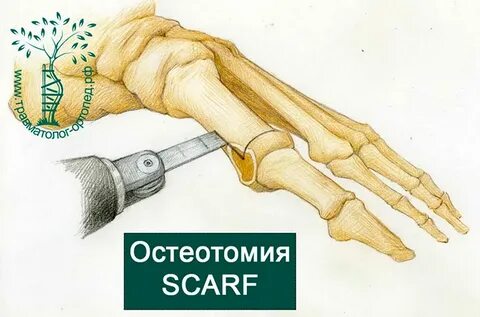 Остеотомия