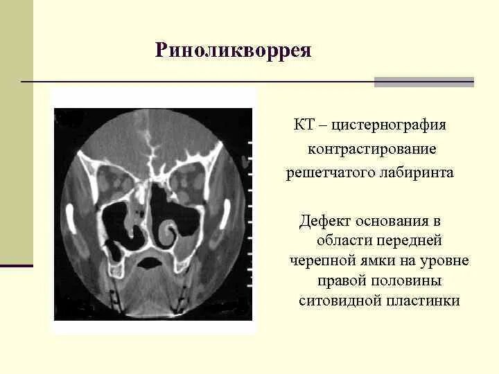 Решетчатый Лабиринт анатомия на кт. Решетчатая кость решетчатый Лабиринт. Анатомия клеток решетчатого Лабиринта на кт. Перпендикулярная пластинка решетчатой кости на кт. Утолщение слизистой оболочки решетчатых лабиринтов