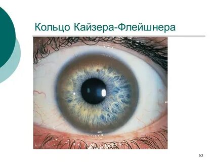 Кайзера флейшера