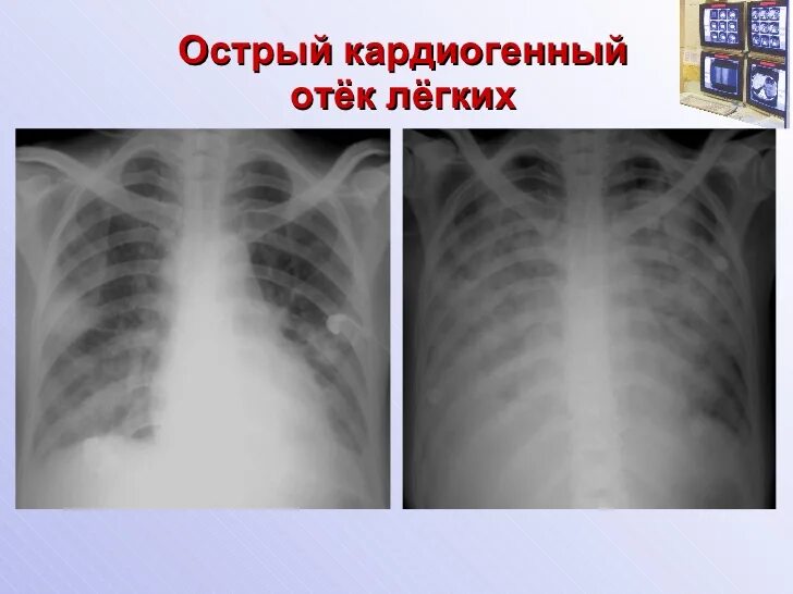 Отек легких причины у пожилых. Кардиогенный отек легких рентген. некардиогенный отек легких рентген. альвеолярный отек легкого рентген. кардиогенный отек легких рентген признаки.
