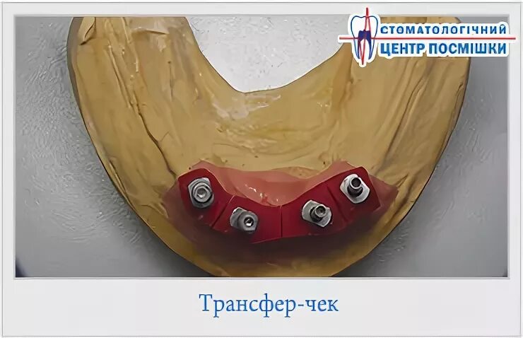 Трансферы чека. Индивидуальная ложка для имплантатов. Индивидуальная ложка под импланты. Снятие оттисков с имплантатов.