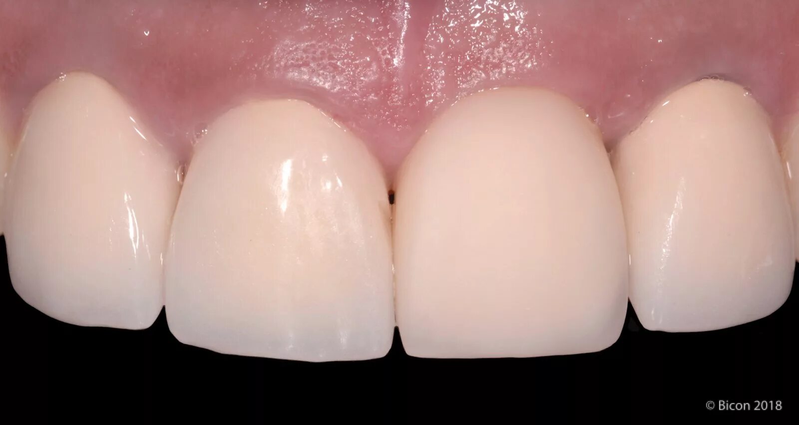 металлокерамическая коронка. коронки на фронтальные зубы. металлокерамическая коронка. металлокерамические коронки на передние зубы. металлокерамическая коронка noritake.