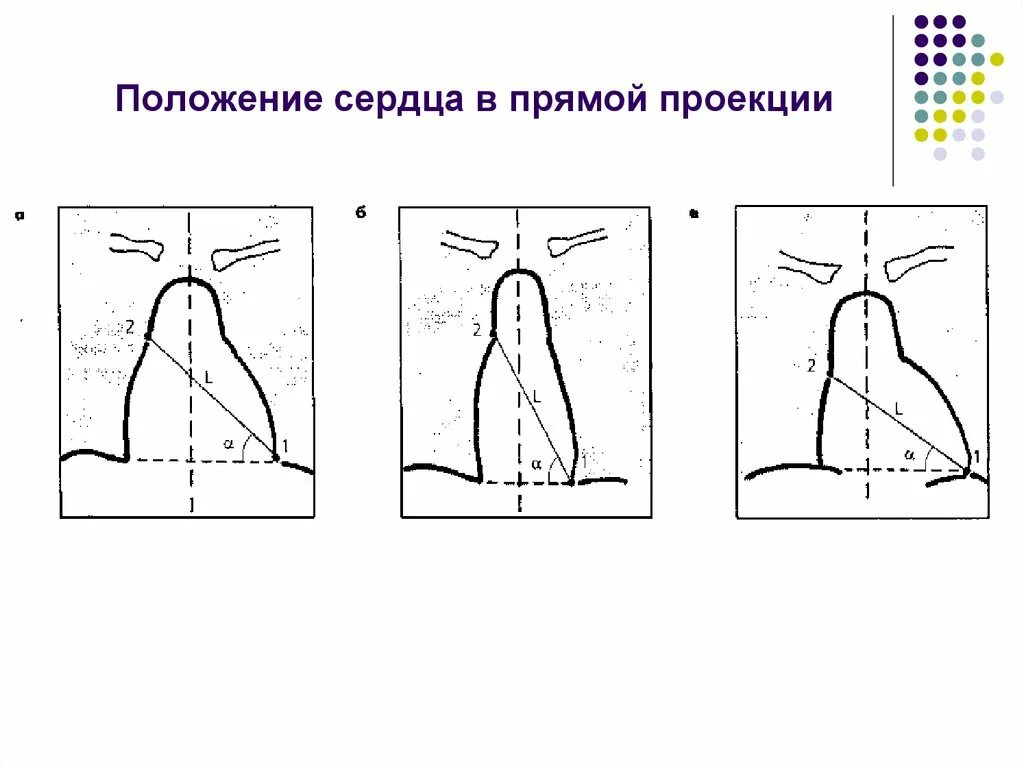 Типы положения сердца. Варианты положения сердца. косое положение сердца. прямое положение сердца.