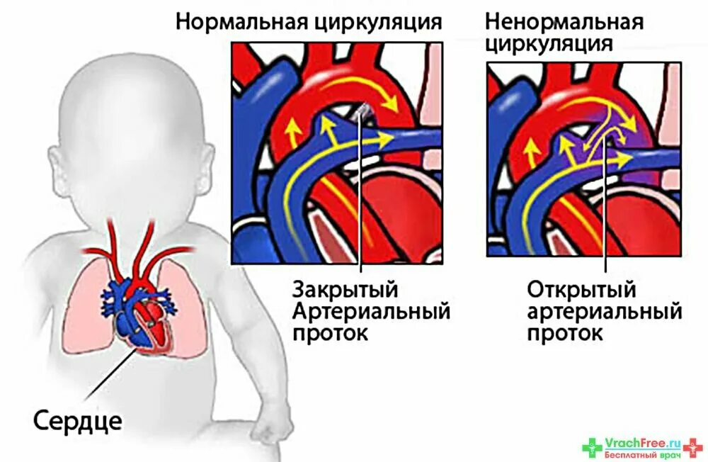 Открытый артериальный проток рентген. Признаки порока сердца у грудничка. Симптомы врожденного порока сердца у новорожденного ребенка. Открытый артериальный проток рентген признаки.