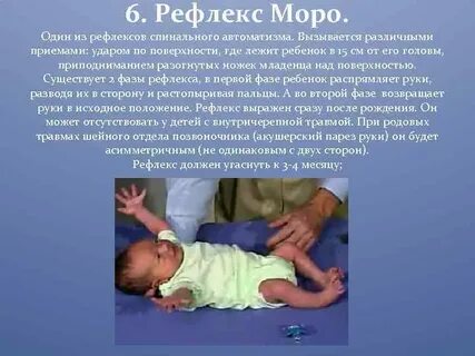Рефлекс моро у новорожденных