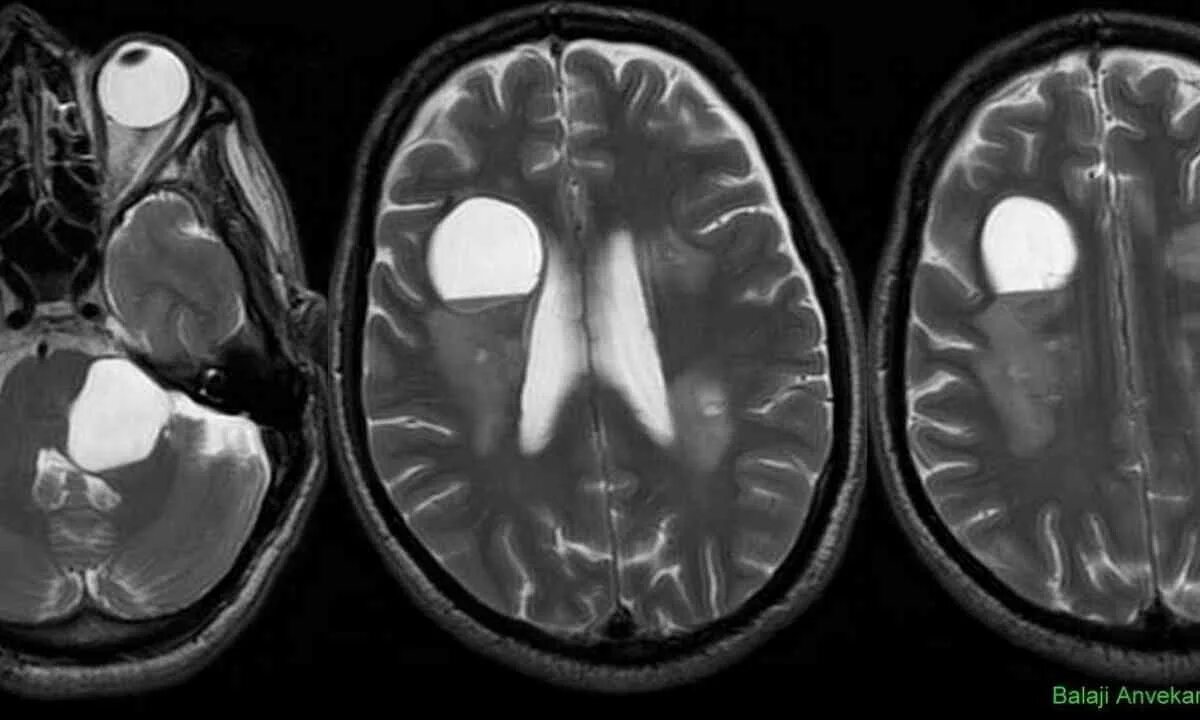 Эхинококкоз головного мозга кт. Эхинококк головного мозга мрт. Киста головного мозга на МР. Арахноидальные изменения ликворокистозного характера