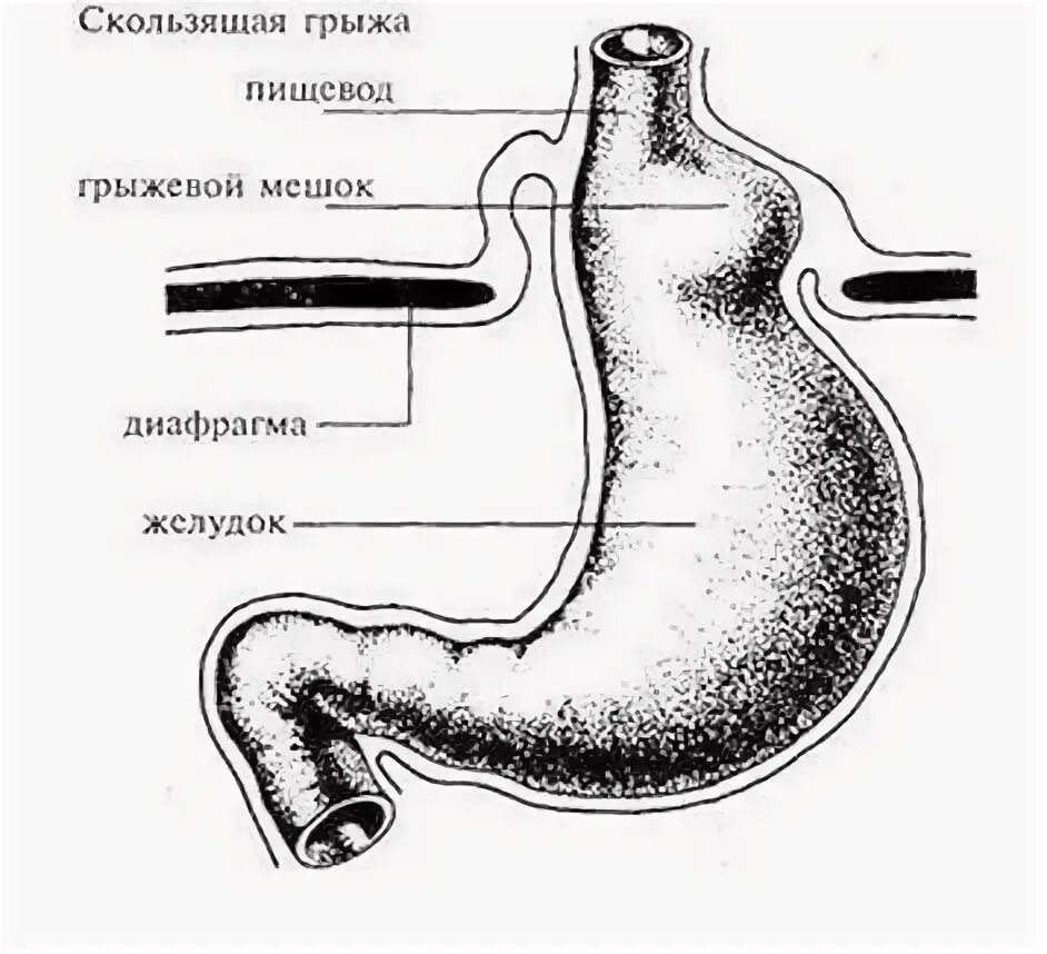 Симптомы грыжи желудка пищевода. Скользящая грыжа желудка. грыжа диафрагмы желудка. желудок диафрагма пищевод.