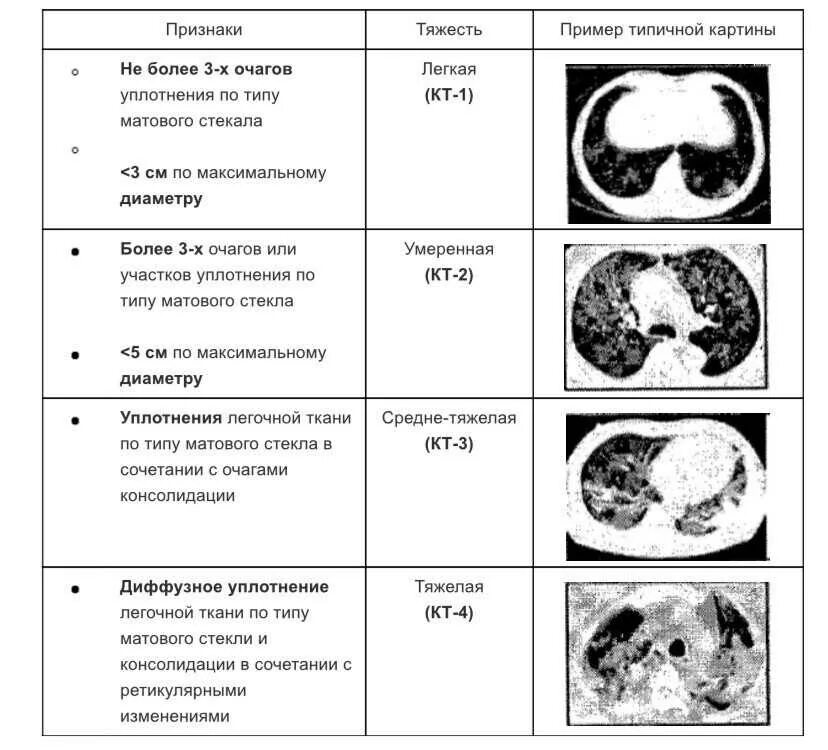 Стадии поражения легких по кт. Классификация ковид пневмонии по кт. Степень ковид пневмонии кт. Поражение легких 3