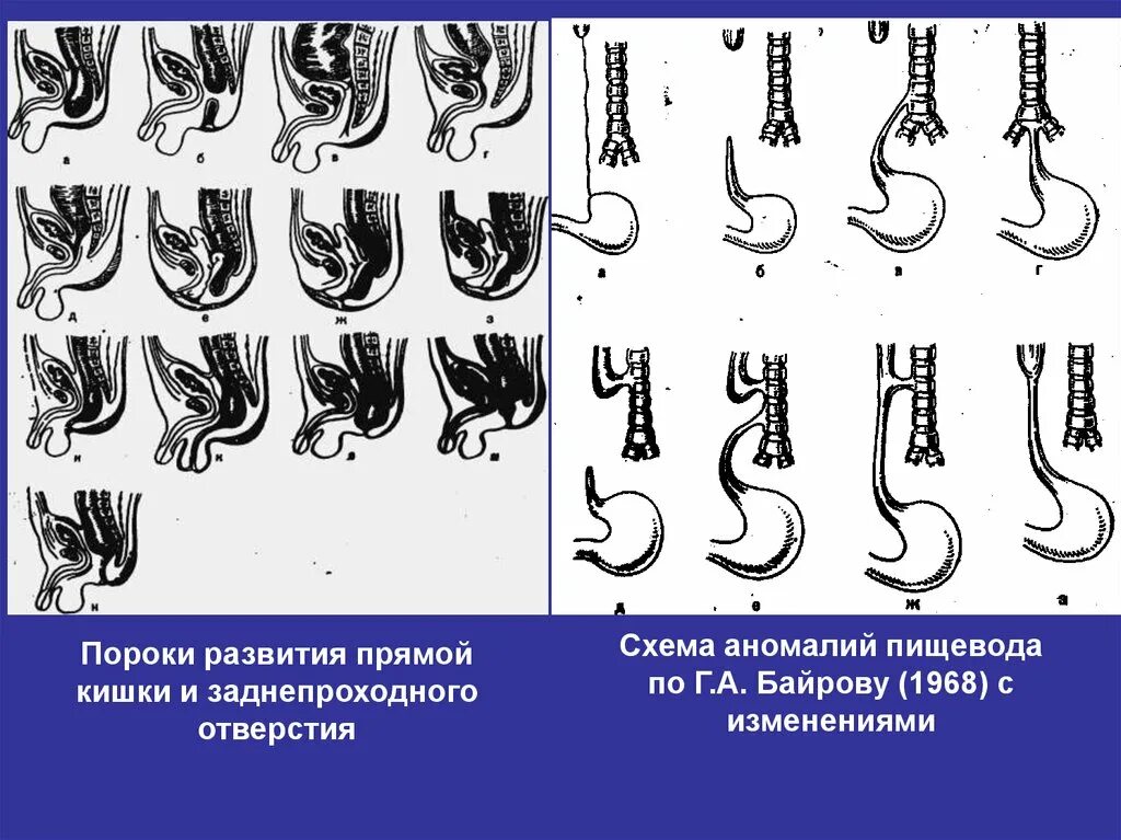 Формирование пищевода. Пороки развития прямой кишки. Пороки развития кишечной трубки. Пороки кишок ВСЭ кишок. Пороки пищеварительной системы.