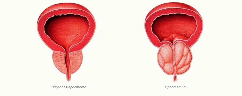 Тазовый простатит. N41.1 - хронический простатит что это. Секрет простаты как выглядит.