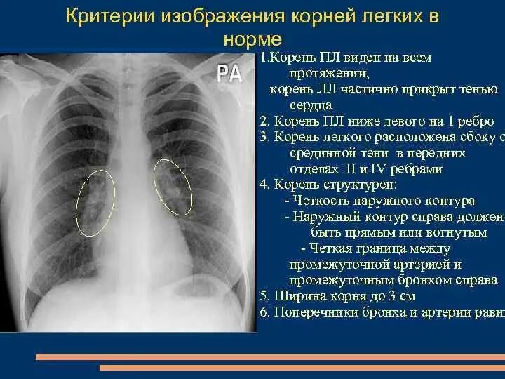 Легочный рисунок смешанного типа