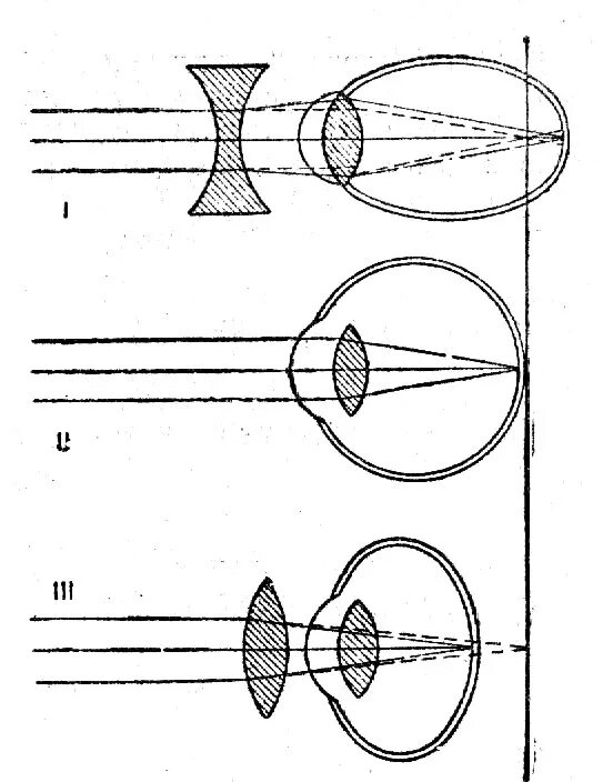 Фокусировка лучей света на внутренней. Схемы рефракции при нормальном зрении. Схемы рефракции при нормальном зрении при миопии при гиперметропии. Близорукость и дальнозоркость схема рефракции. Схемы хода лучей в глазе при близорукости и дальнозоркости.