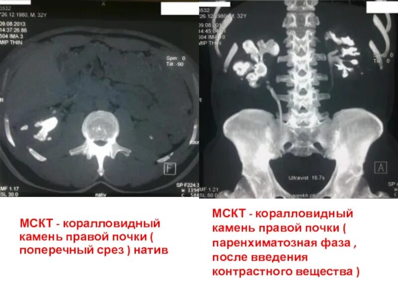 Камни на кт видны. Мочекаменная болезнь коралловидные камни. Коралловидный камень в почке кт. Коралловидный камень почки СКТ. Кт почек мочекаменная болезнь.