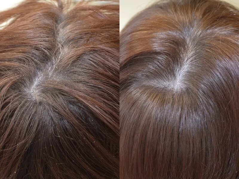 Пилинг от перхоти. Пилинг от перхоти. Vichy dercos micro peel 3-в-1 шампунь-пилинг 200мл. Пилинг волос головы. Пилинг от перхоти.