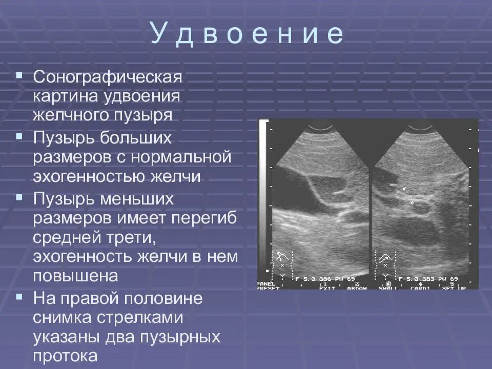 Изменение стенок желчного пузыря. Удвоение стенки желчного пузыря. Передняя стенка желчного пузыря на УЗИ. Желчный пузыри на УЗИ эхогенность.