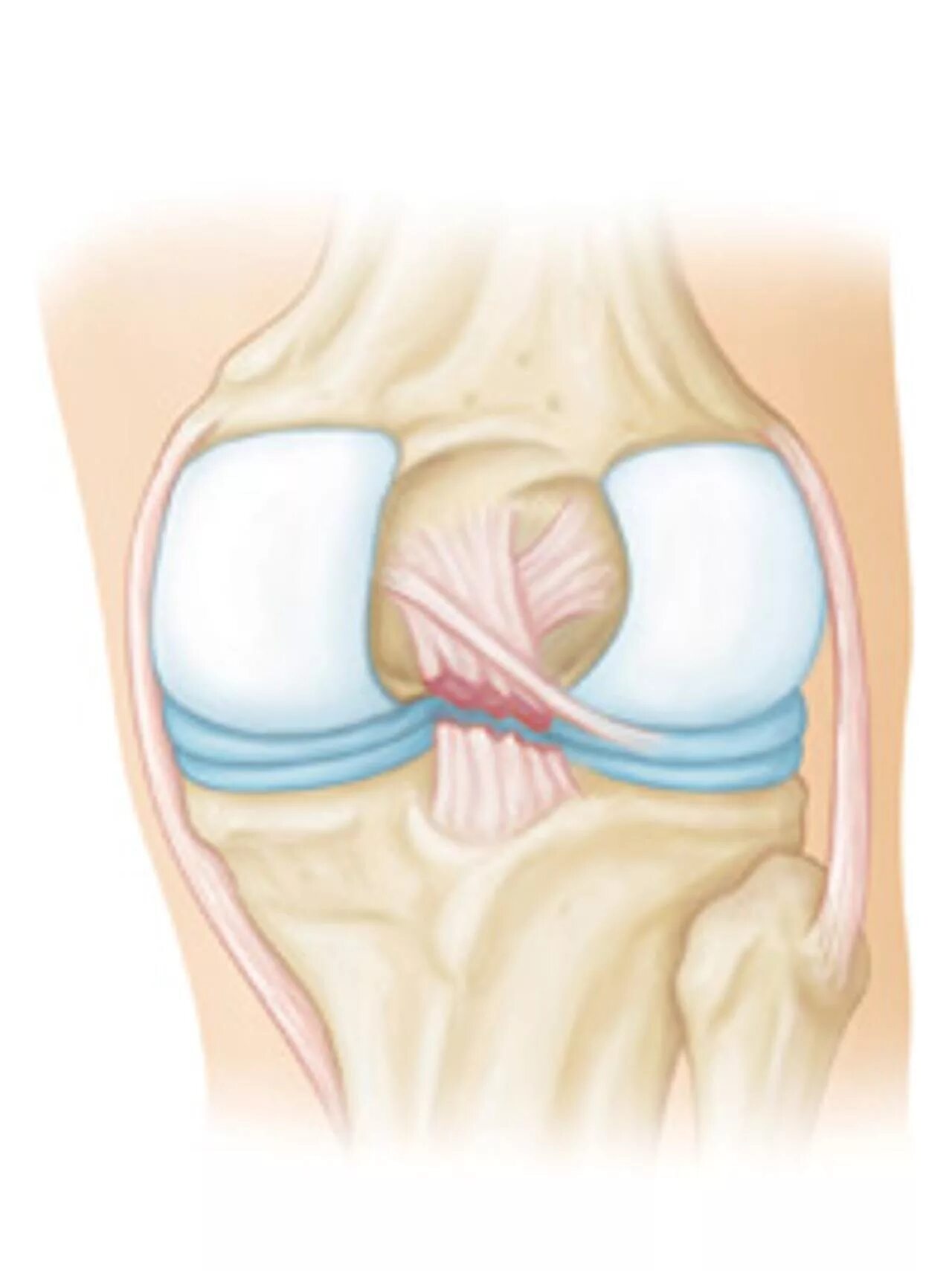 Симптомы крестообразной связки коленного сустава. Растяжение ПКС коленного сустава. Разрыв ПКС коленного сустава. Надрыв ПКС коленного сустава.
