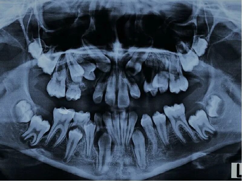 3 5 8 зуб. Ретинированный клык ОПТГ. Ретенция и дистопия зуба. ОПТГ ретинированный дистопированный.