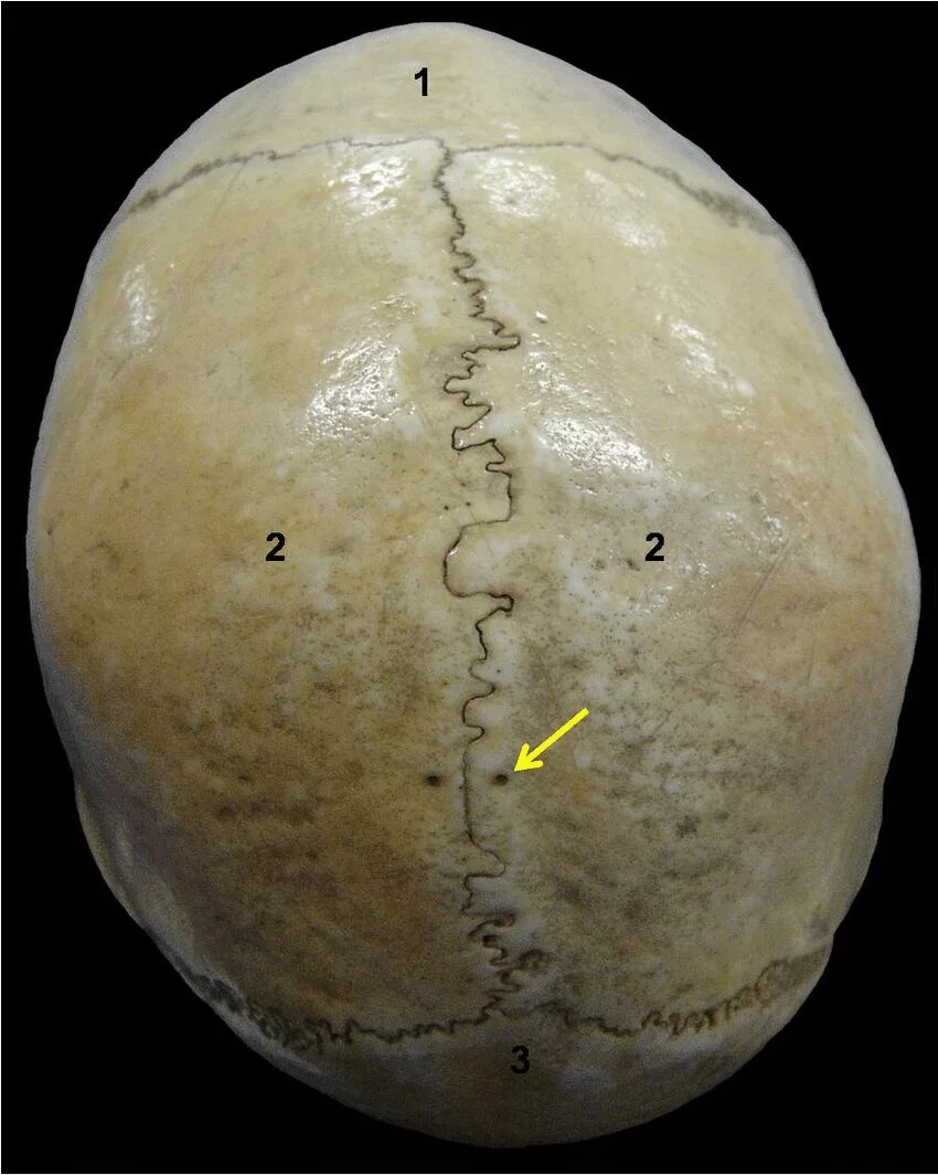2 теменные кости. Теменная кость черепа. Форамен париетале. Кости черепа теменные Бугры. Foramen parietale анатомия.