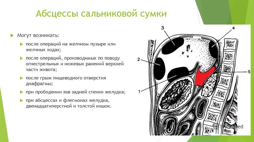 Винслово отверстие. Топография сальниковой сумки. Схема формирования сальниковой сумки. Абсцесс сальниковой сумки кт. Сальниковое отверстие топографическая анатомия.