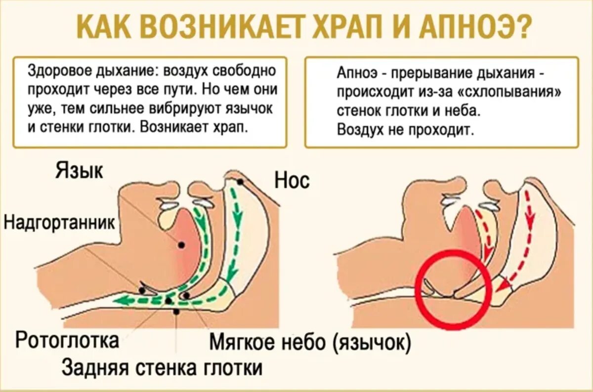 Почему стал храпеть. Остановка дыхания во сне. Храп у мужчин. Причина храпа во сне у женщин.