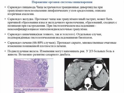 Очаговые поражения печени