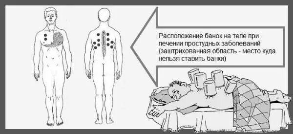 На сколько ставят банки взрослым. Как ставить банки на спину правильно при кашле схема. Как правильно ставить банки на спину при кашле взрослому схема. Схема постановки медицинских банок при бронхите. Схема установки вакуумных банок на спину.