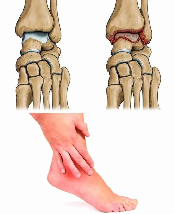 Артрит это. Остеоартрит голеностопного сустава. Ревматоидный артрит голеностопа. Деформирующий артроз голеностопа. Артрит и артроз голеностопного сустава.