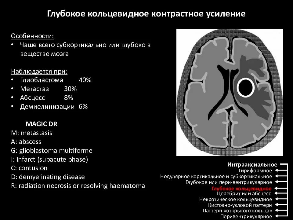 Усиленный в базальных отделах. Абсцесс головного мозга мрт контраст. Плотность серого и белого вещества головного мозга кт. Плотность вещества головного мозга при кт. Образование головного мозга кт.