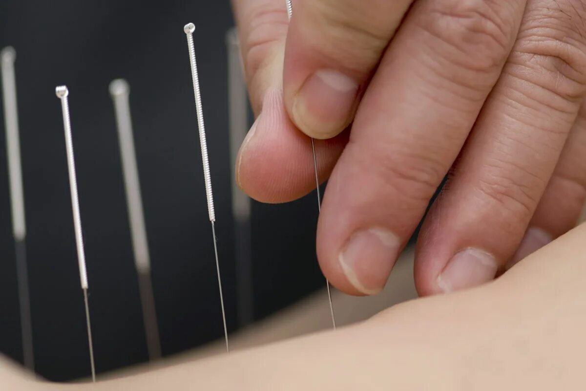 Точки на теле от пьянства. Иглоукалывание при простатите. Помогут иглоукалывание от алкоголизма. Кодировка иглоукалыванием. Кодировка иглоукалыванием.