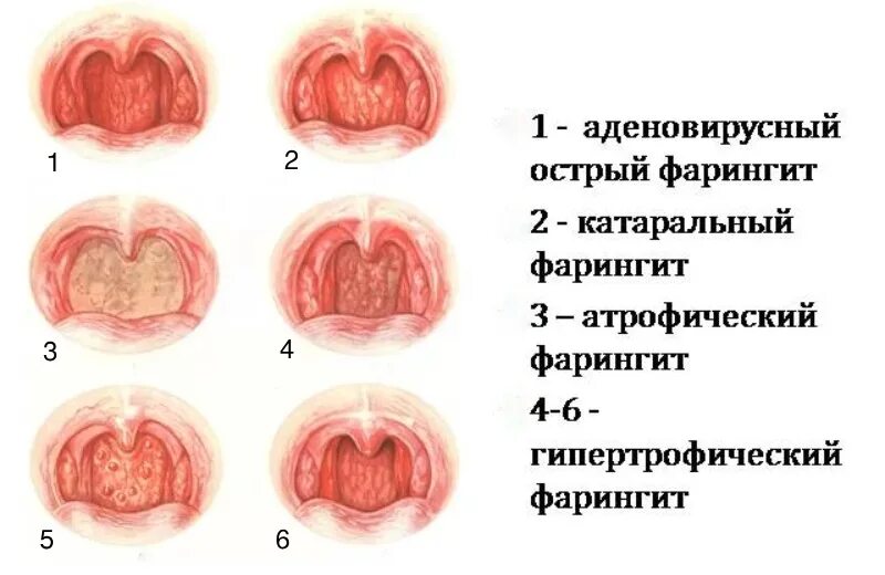 Зев красный. Хронический гранулярный фарингит. Гипертрофический Гнойный фарингит. Острый и хронический катаральный фарингит. Острый и хронический фарингит формы.