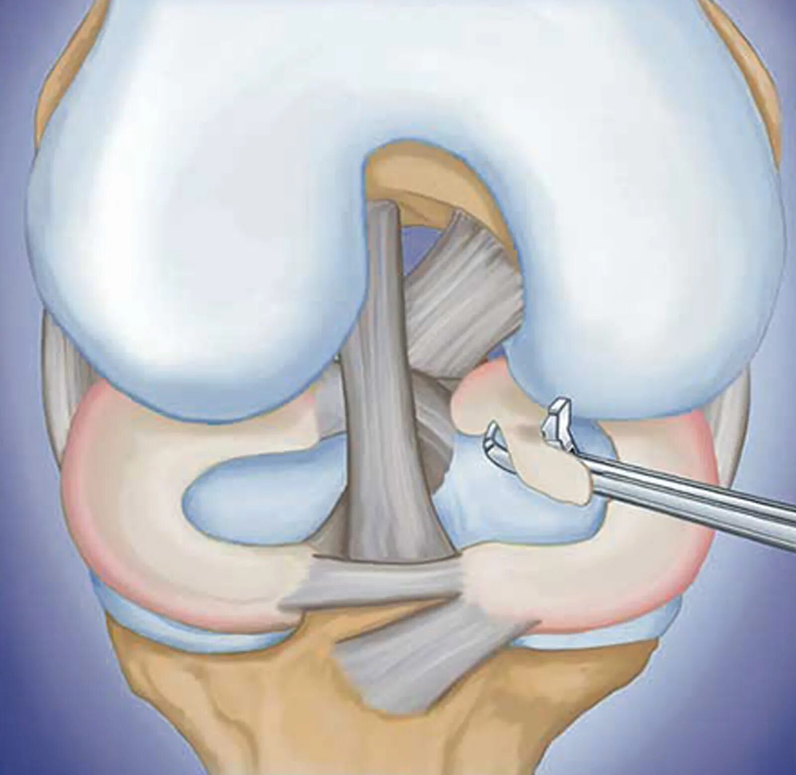 Поврежденный мениск коленного сустава. Артроскопия резекция мениска. Артроскопический шов мениска коленного сустава. Артроскопия мениска коленного сустава. Мениск коленного сустава операция.