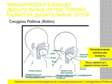 Аспирационный синдром у новорожденных