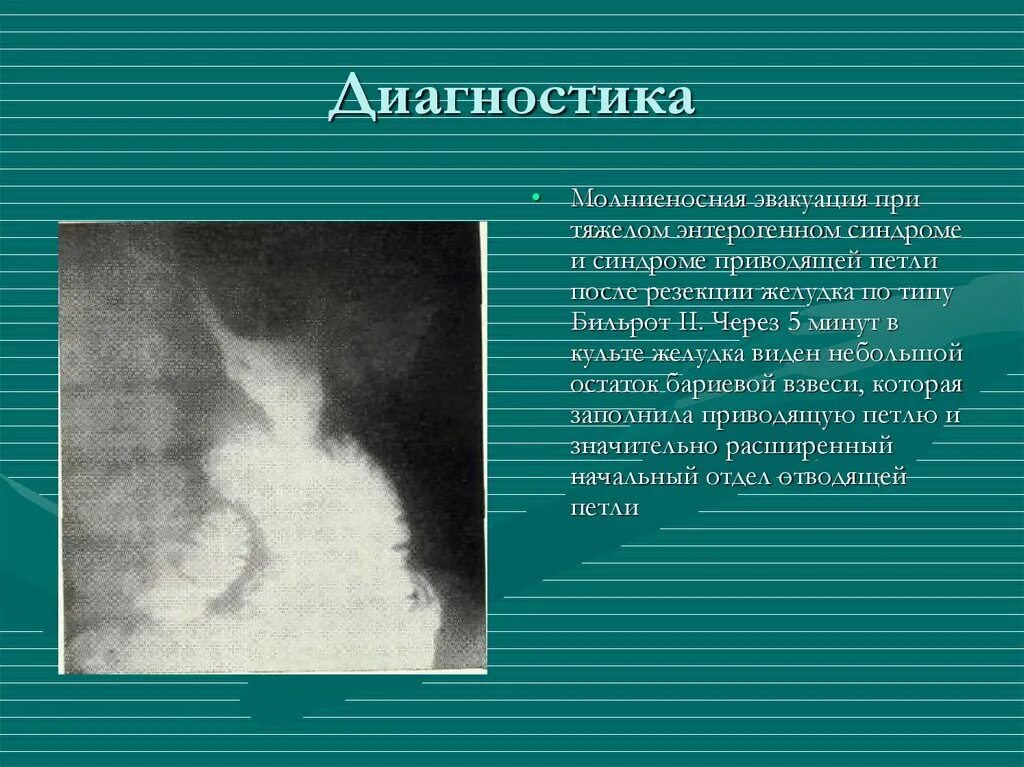Демпинг синдром после резекции желудка. Синдром приводящей петли диагностика. синдром приводящей петли после резекции. диагноз после резекции желудка. диагностика синдрома приводящей кишки.