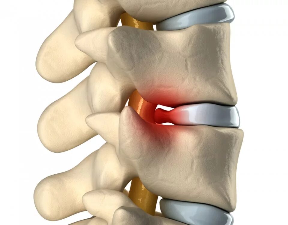 Грыжи дисков поясничного отдела позвоночника. Протрузия межпозвоночного диска l5-s1. Остеохондроз протрузия грыжа. Имплант межпозвонкового диска l5-s1. Протрузия межпозвонковых дисков l4-5.