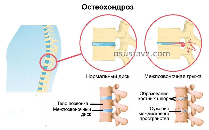 Остеохондроз грудного отдела позвоночника симптомы. Межпозвонковый остеохондроз грудного отдела. Остеохондрома грудного отдела. Остеохондроз грудного и поясничного отделов позвоночника. Остеохондроз шейного и грудного отдела позвоночника лечение