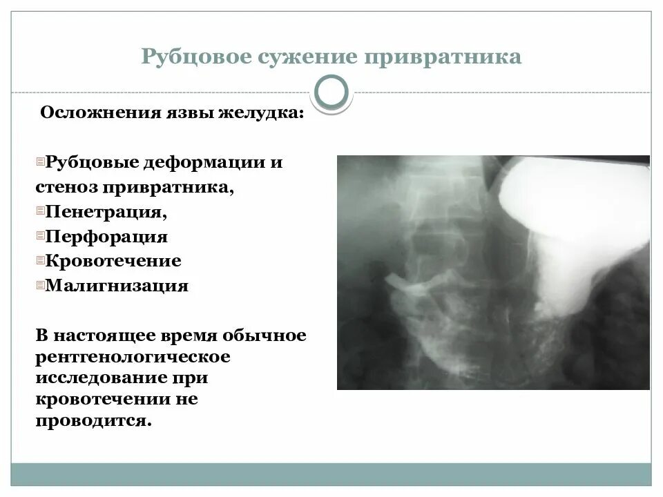 Осложнения стеноза