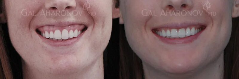 Tıp dilinde gingival resesyon olarak tanımlanan diş eti çekilmesinin farklı fark