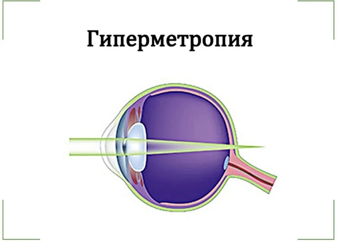 13. Дальнозоркость (гиперметропия).. Патология рефракции гиперметропия. Изометрическая гиперметропия. Гиперметропия глаза что это такое. Болезнь дальнозоркость