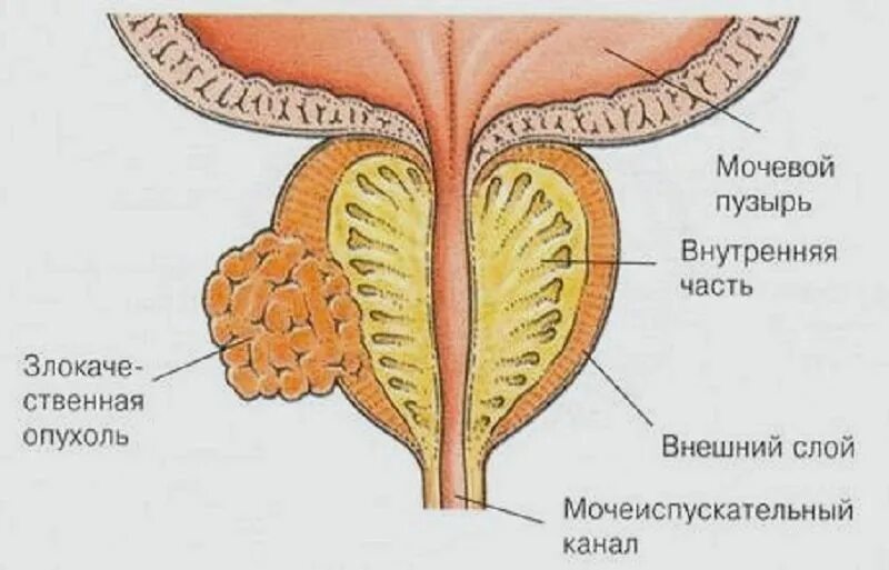 Предстательная железа функции у мужчин. Предстательная железа у мужчин. Опухоль на предстательной железе. Простата и предстательная железа.