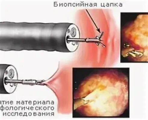 Биоптат кишки. Биопсия при эндоскопическом исследовании.