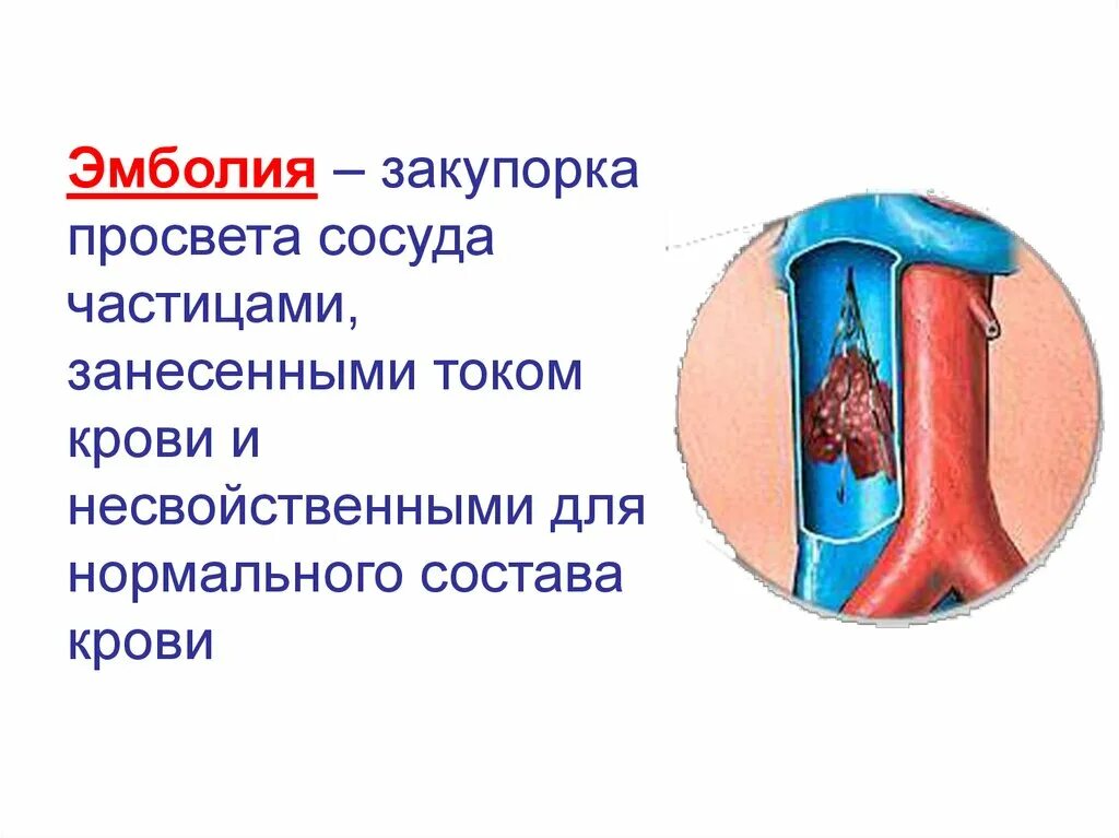 Кровь закупорка сосудов. Закупорка просвета сосуда это.