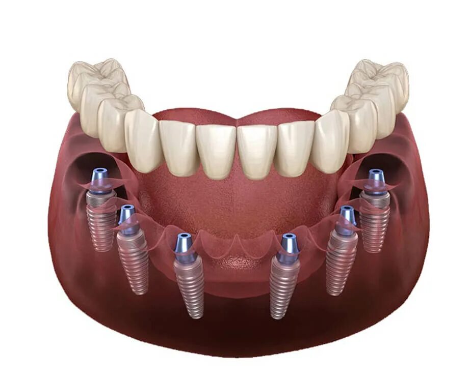 All on 6 цена. Имплантация зубов по технологии «all on 4». Имплантация челюсти на 6 имплантах.