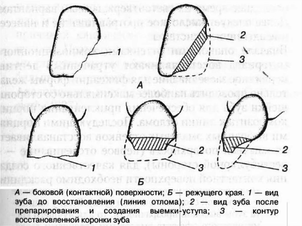 Поверхности зуба схема. Апроксимальная поверхность зуба. Схема реставрации фронтальных зубов. Контактная поверхность зуба. Изгиб зубов