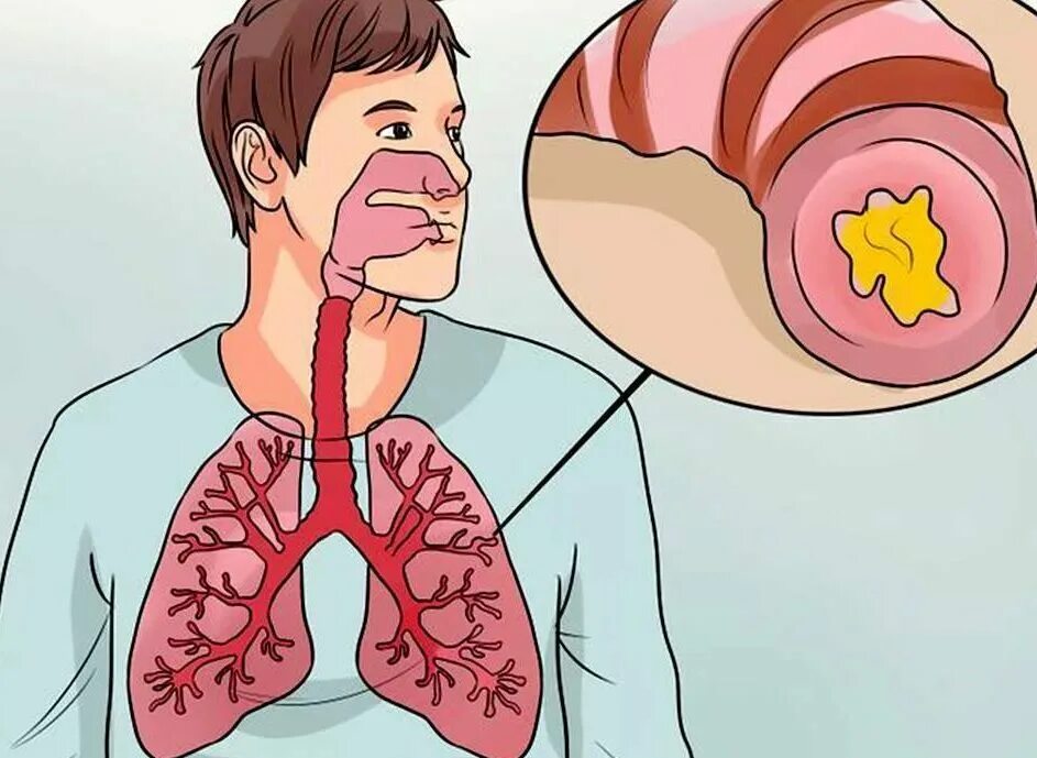 Выведение мокроты из легких. Хронический бронхит кашель. Накопление мокроты в бронхах.
