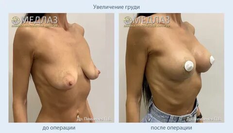 Увеличение груди, врач Пиманчев П.В. 